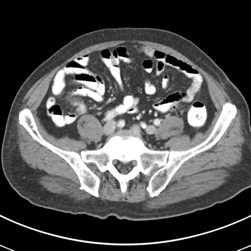 Abdominal wall metastasis from colorectal carcinoma (Radiopaedia 31016-31717 Axial C+ portal venous phase 54).jpg