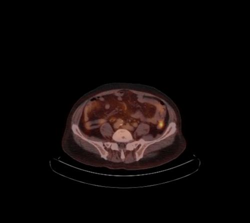 Abdominal wall metastasis from colorectal carcinoma (Radiopaedia 31016-31719 C 47).jpg
