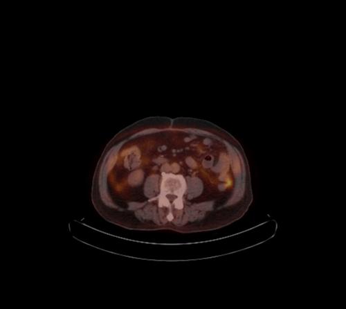 Abdominal wall metastasis from colorectal carcinoma (Radiopaedia 31016-31719 C 57).jpg