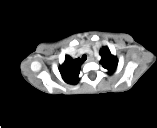 File:Abdominopelvic rhabdomyosarcoma (Radiopaedia 78356-90984 Axial C+ portal venous phase 4).jpg