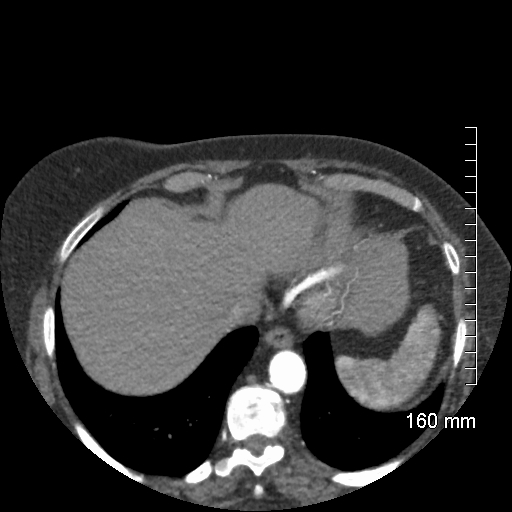 Aberrant right subclavian artery stenosis (Radiopaedia 52656-58670 Axial C+ arterial phase 67).jpg
