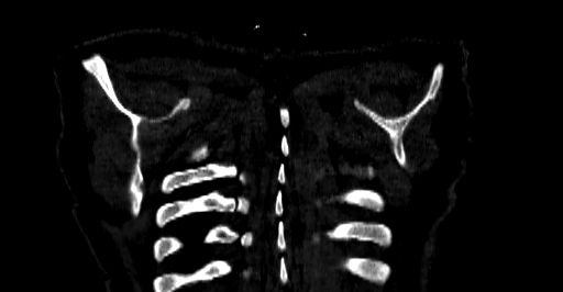 Accesory rib joint (Radiopaedia 71987-82452 Coronal bone window 87).jpg