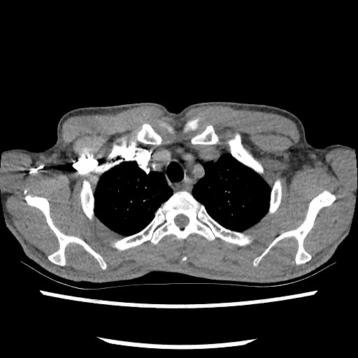 Accessory left horizontal fissure with lingular pneumonia (Radiopaedia 53763-59843 Axial C+ CTPA 17).jpg