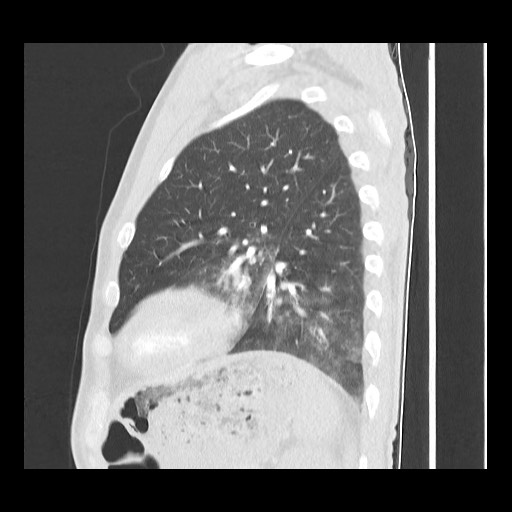 Accessory left horizontal fissure with lingular pneumonia (Radiopaedia 53763-59843 Sagittal lung window 51).jpg