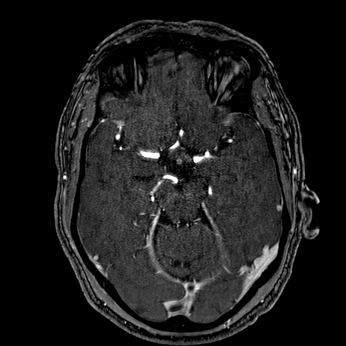 Accessory middle cerebral artery (Radiopaedia 73114-83828 Axial MRA 72).jpg