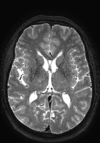 Accessory middle cerebral artery (Radiopaedia 73114-83828 Axial T2 62).jpg