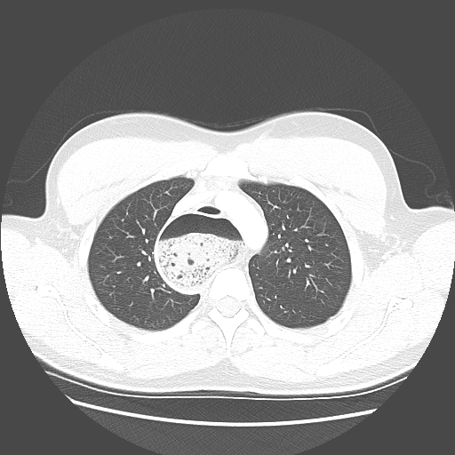 Achalasia (Radiopaedia 52507-58417 Axial lung window 16).jpg