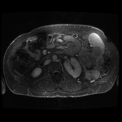 Acinar cell carcinoma of the pancreas (Radiopaedia 75442-86668 Axial T1 C+ fat sat 26).jpg