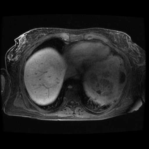 Acinar cell carcinoma of the pancreas (Radiopaedia 75442-86668 Axial late phase (~30 mins) 131).jpg