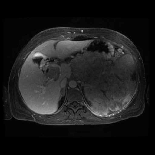 Acinar cell carcinoma of the pancreas (Radiopaedia 75442-86668 D 89).jpg