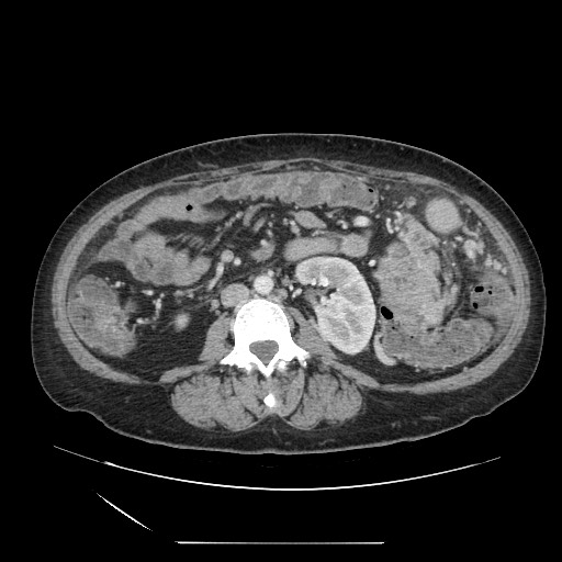 Acinar cell carcinoma of the pancreas (Radiopaedia 75442-86669 Axial C+ portal venous phase 76).jpg