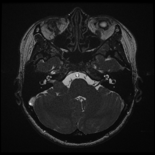 Acoustic neuroma (Radiopaedia 34049-35283 Axial 49).png