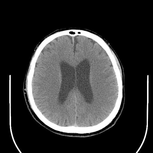 File:Acoustic schwannoma (Radiopaedia 39170-41388 Axial non-contrast 32).png