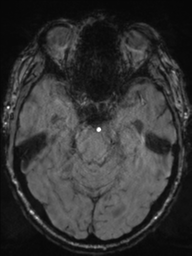 Acoustic schwannoma (Radiopaedia 55729-62281 Axial SWI 18).png