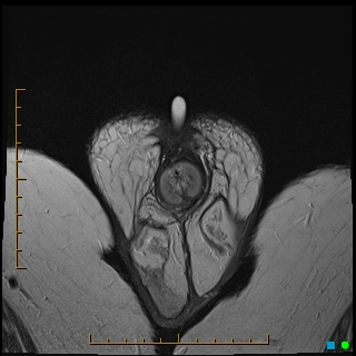 File:Acquired buried penis (Radiopaedia 39478-41797 Axial T2 37).jpg