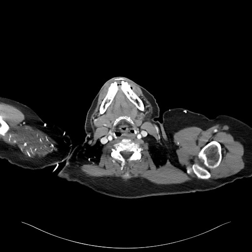 Acromioclavicular joint cyst (Radiopaedia 58455-65610 Axial C+ arterial phase 5).jpg