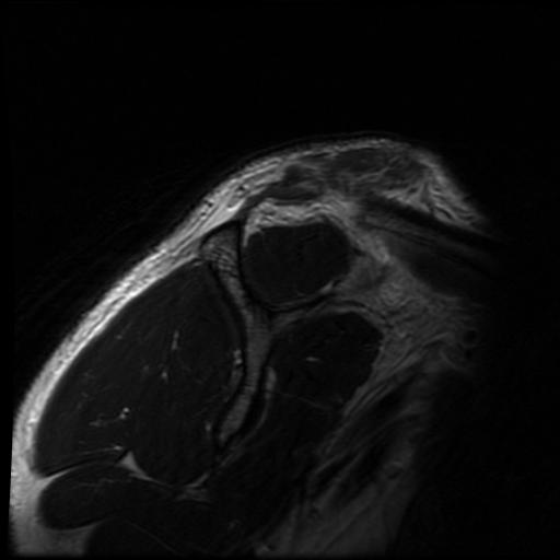 File:Acromioclavicular joint dislocation (Radiopaedia 14218-14076 Sagittal T2 14).jpg