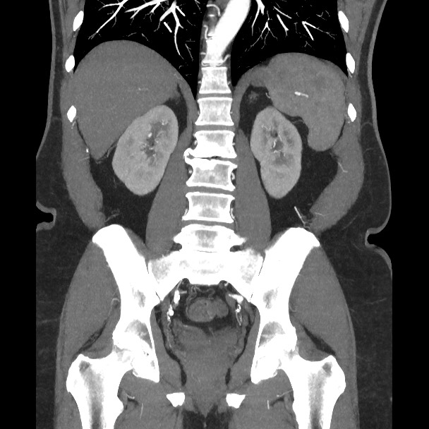 Active colonic bleed on CT (Radiopaedia 49765-55025 Coronal art MIP 42).jpg