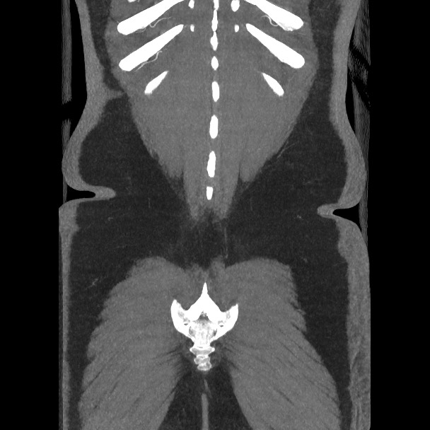 Active colonic bleed on CT (Radiopaedia 49765-55025 Coronal art MIP 56).jpg