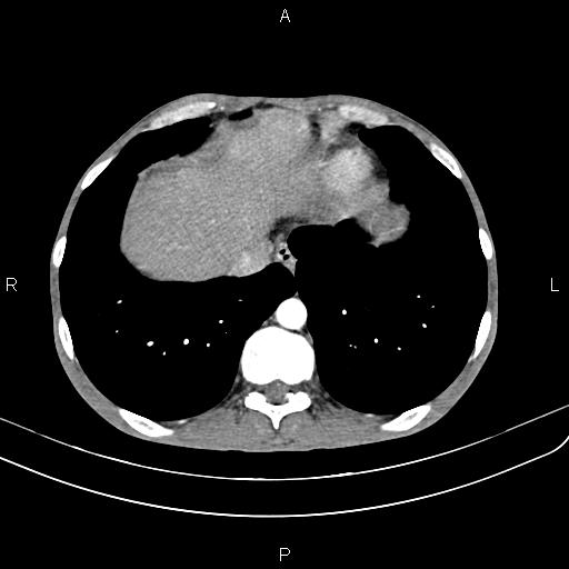 Active crohn disease (Radiopaedia 87133-103397 Axial C+ arterial phase 12).jpg