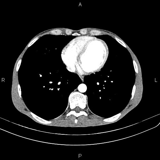 Active crohn disease (Radiopaedia 87133-103397 Axial C+ arterial phase 3).jpg