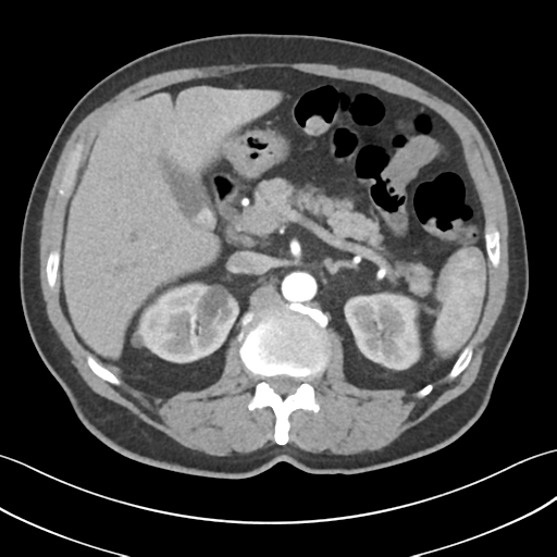 File:Active diverticular hemorrhage (Radiopaedia 39415-41725 Axial C+ arterial phase 20).png