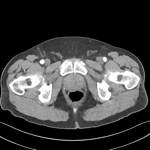 Active diverticular hemorrhage (Radiopaedia 39415-41725 Axial C+ arterial phase 72).png