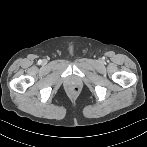 File:Active diverticular hemorrhage (Radiopaedia 39415-41725 Axial C+ portal venous phase 75).png