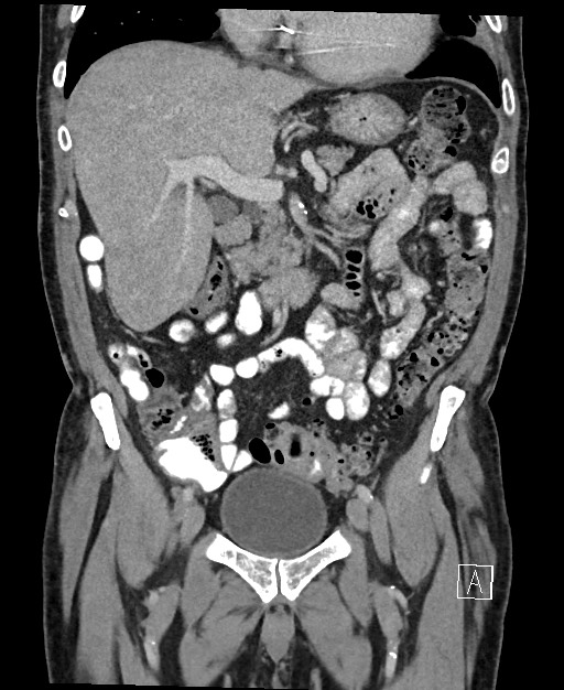 Active lower gastrointestinal bleeding - diverticular (Radiopaedia 61203-69106 Coronal C+ portal venous phase 58).jpg