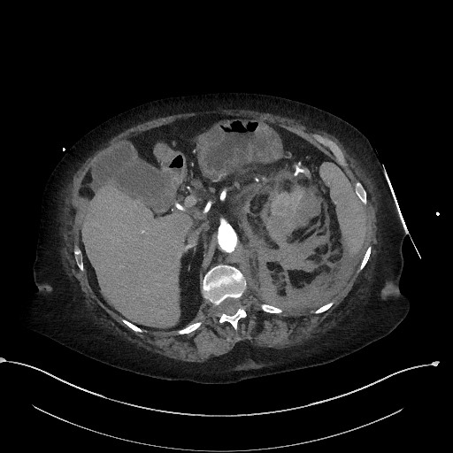 Active renal extravasation with large subcapsular and retroperitoneal hemorrhage (Radiopaedia 60975-68796 Axial C+ arterial phase 62).jpg