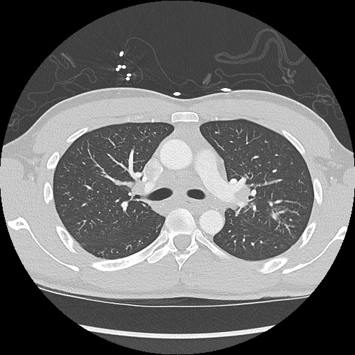 File:Active right ventricular cardiac sarcoidosis (Radiopaedia 55596-62101 Axial lung window 14).jpg