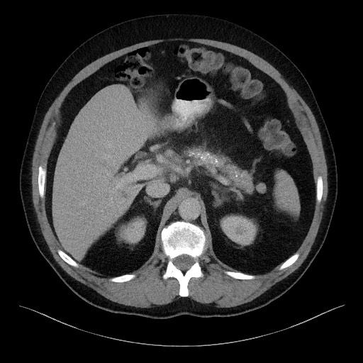 File:Acute-on-chronic pancreatitis (Radiopaedia 67286-76656 Axial C+ portal venous phase 23).jpg