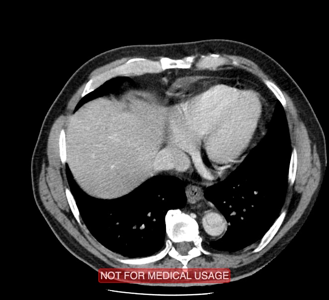 Acute aortic dissection - Stanford type A (Radiopaedia 40661-43285 Axial C+ portal venous phase 46).jpg