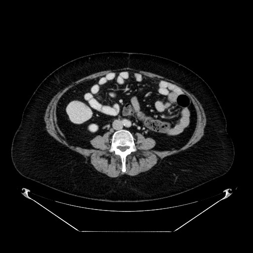 Acute appendicitis, heterotaxy syndrome (Radiopaedia 66884-76202 Axial C+ portal venous phase 75).jpg