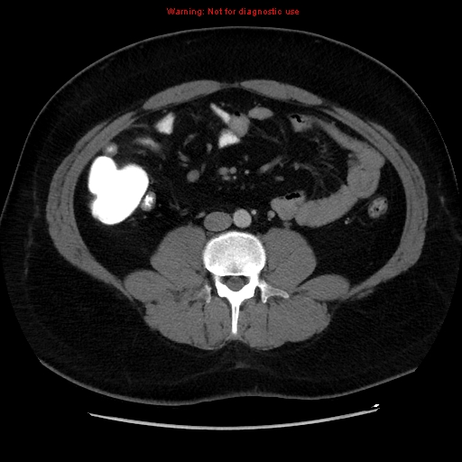 File:Acute appendicitis (Radiopaedia 12326-12607 Axial C+ portal venous phase 2).jpg