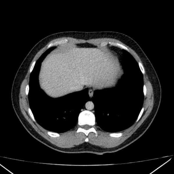 Acute appendicitis (Radiopaedia 38255-40270 Axial C+ portal venous phase 8).jpg