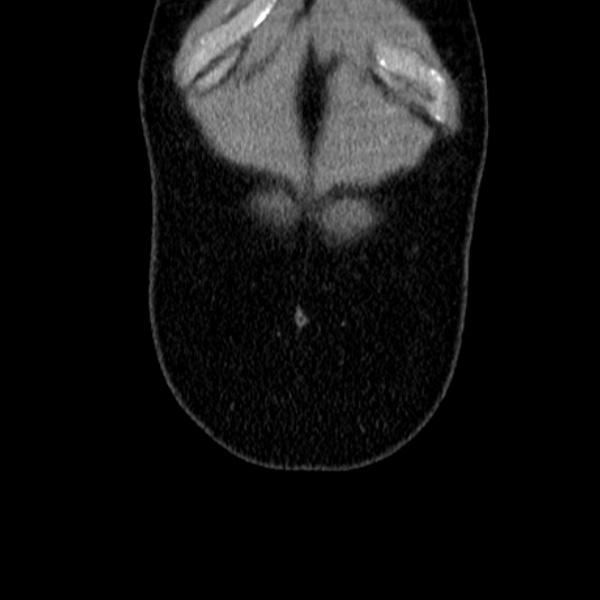 Acute appendicitis (Radiopaedia 38255-40270 Coronal C+ portal venous phase 10).jpg