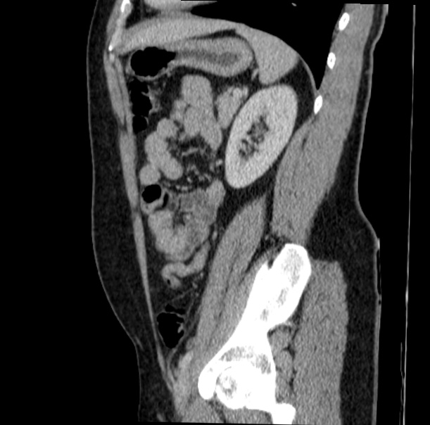 Acute appendicitis (Radiopaedia 38255-40270 Sagittal C+ portal venous phase 59).jpg