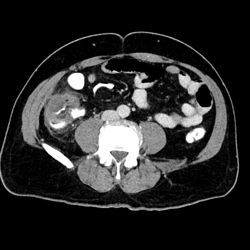 File:Acute appendicitis (Radiopaedia 77016-88960 Axial C+ portal venous phase 88).jpg