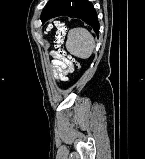 File:Acute appendicitis (Radiopaedia 84780-100240 Sagittal C+ portal venous phase 97).jpg
