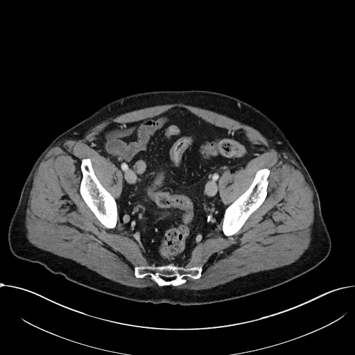 File:Acute appendicitis - large appendicoliths (Radiopaedia 61805-69820 Axial C+ portal venous phase 109).jpg