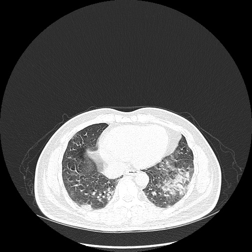 File:Acute appendicitis and COVID 19 pneumonia (Radiopaedia 76604-88380 Axial lung window 40).jpg