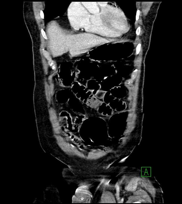 Acute arterial mesenteric ischemia (Radiopaedia 78238-90828 Coronal C+ portal venous phase 26).jpg