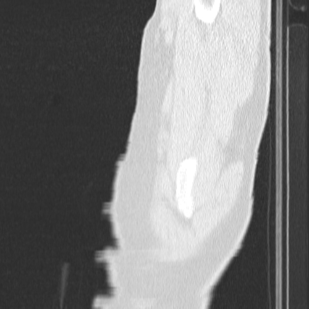 Acute aspiration pneumonitis (Radiopaedia 33605-34703 Sagittal lung window 2).jpg