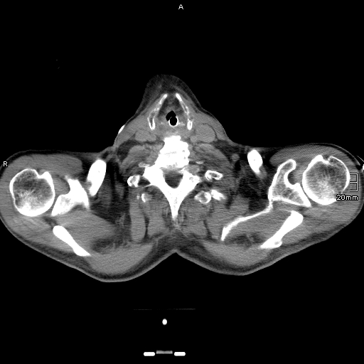 Acute aspiration pneumonitis (Radiopaedia 55642-62166 Axial liver window 3).jpg