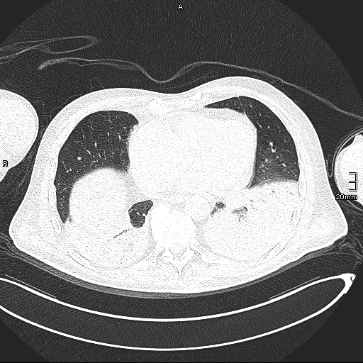Acute aspiration pneumonitis (Radiopaedia 55642-62166 Axial lung window 110).jpg
