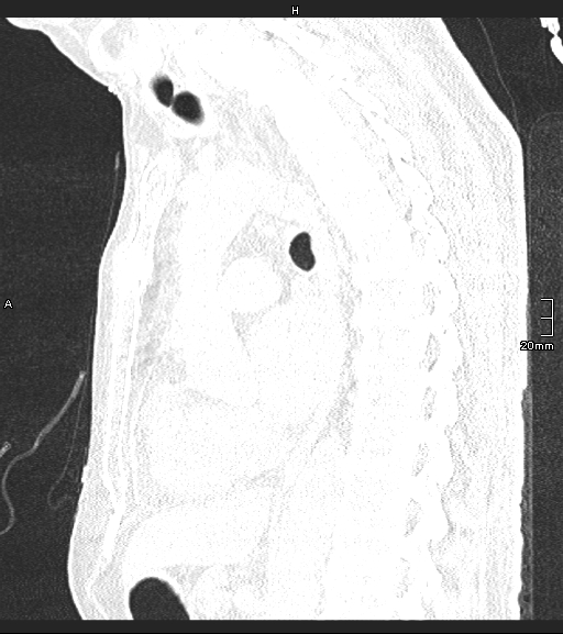 Acute aspiration pneumonitis (Radiopaedia 55642-62166 Sagittal lung window 71).jpg