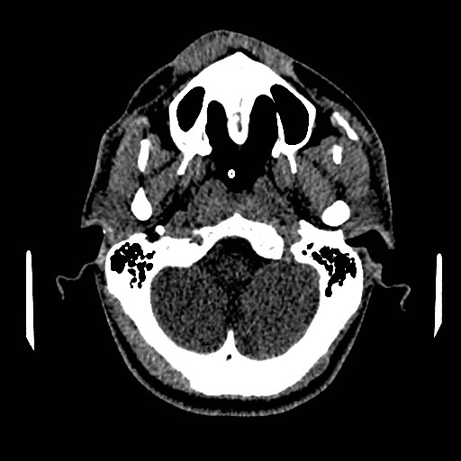 Acute basilar artery occlusion (Radiopaedia 43582-46985 Axial non-contrast 37).jpg
