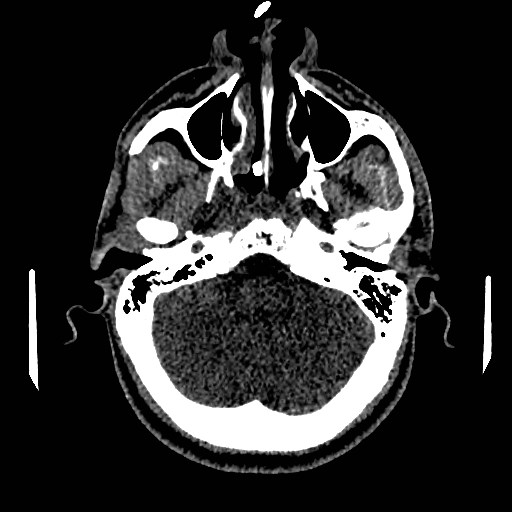 Acute basilar artery occlusion (Radiopaedia 43582-46985 Axial non-contrast 48).jpg