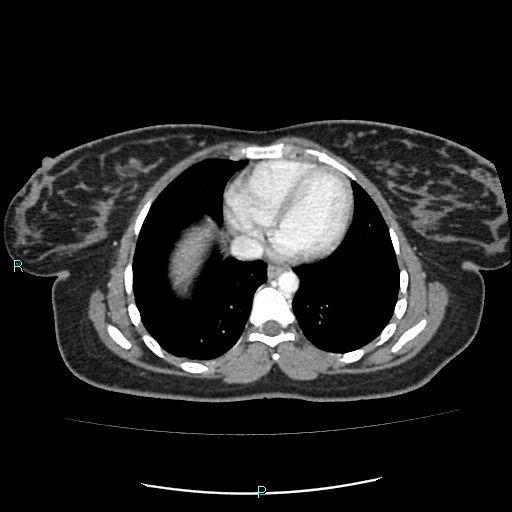 Acute bilateral pyelonephritis (Radiopaedia 37146-38881 Axial C+ portal venous phase 1).jpg